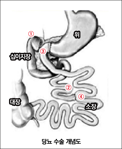 당뇨수술개념도