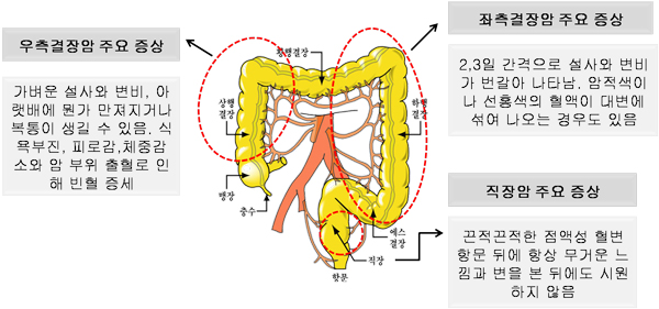 대장암 알리는 위험신호