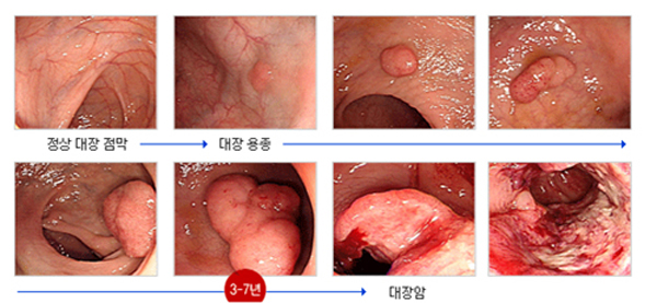 대장암